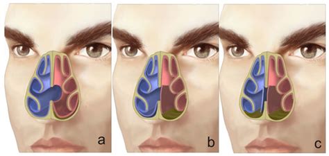 Septal Perforation - Rhinoplasty Archive