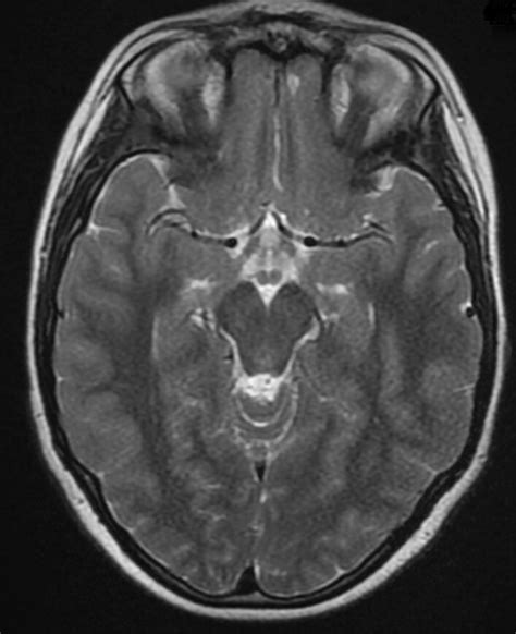 Image of brain MRI scan, Ax T2 FSE. Image of a brain MRI scan performed ...