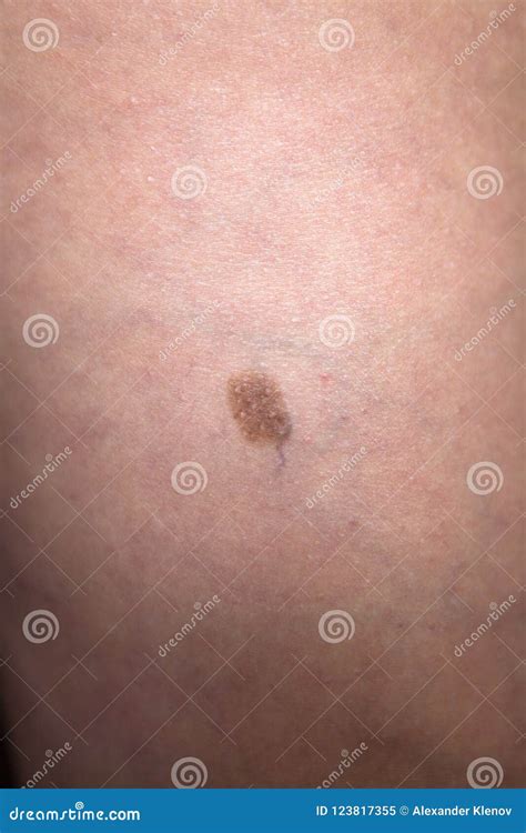 A Small Birthmark On Human Skin Stock Image Image Of Body Macro