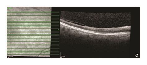 Optical Coherence Tomography Showing Inner Retinal Thickening And