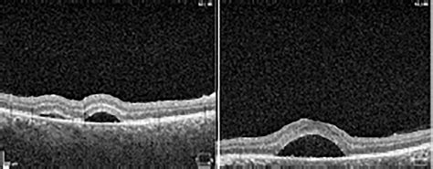 Scielo Brasil Serous Retinal Detachment As An Early Manifestation