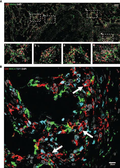 Frontiers Case Report Exceptional Response To Nivolumab Plus