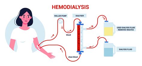 Hemodialysis