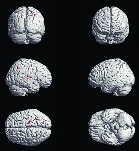 Significantly Activated Brain Regions Of Between Group Analysis On Ee R Download Scientific