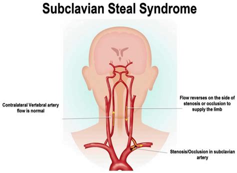 Subclavian Steal Syndrome Causes Symptoms Diagnosis And Treatment