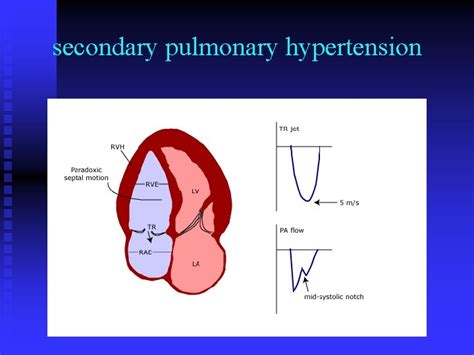 Pulmonary Hypertension Kazemi Toba M D Birjand University