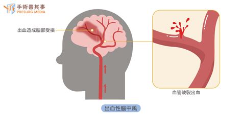 認識動脈內取血栓術 避免腦中風後變植物人