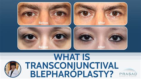 What Is Transconjunctival Lower Blepharoplasty YouTube