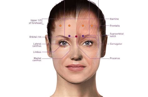 Migraine Botox Injection Sites Diagram