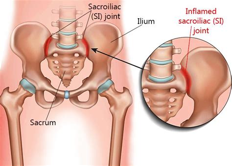 Sacroiliac Joint Dysfunction