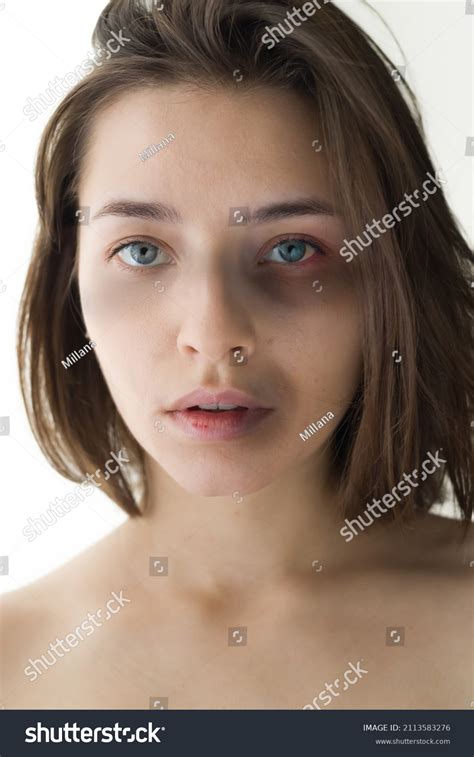 Portrait Girl Bruises On Her Face Stock Photo Shutterstock