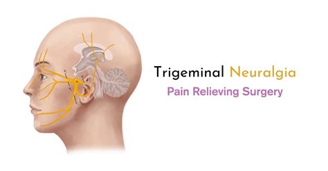 How To Cope With Trigeminal Neuralgia Pain Sri Ramakrishna Hospital