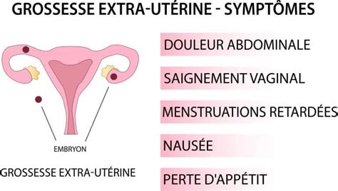 Grossesse Extra Ut Rine Les Signes Qui Alertent Information