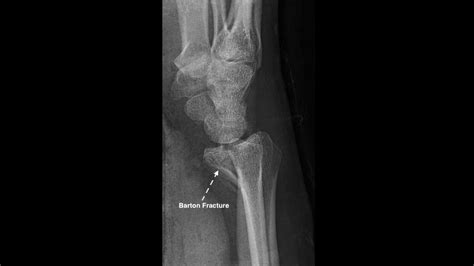 Wrist X-ray Interpretation - OSCE Guide | Geeky Medics