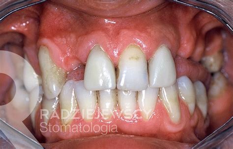 Metamorfozy Stomatologia Radziejewscy Ortodoncja I Nak Adki Invisalign