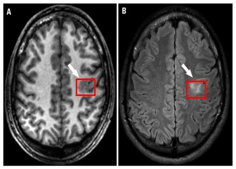 Brain Sciences Free Full Text Detecting Cortical Thickness Changes