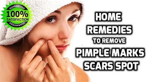 How To Remove Pimples Fast At Home 8 Quick Home Remedies To Remove Acne Overnight Youtube