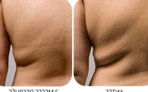 Cu L Es La Diferencia Entre Coolsculpting Y Criolipolisis Dorothy S