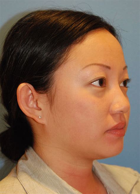 Asian Plastic Surgery Before And After Photos Seattle Bellevue