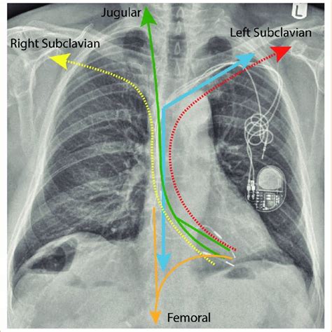 The Applied Forces In Modern Transvenous Lead Extraction Demonstration