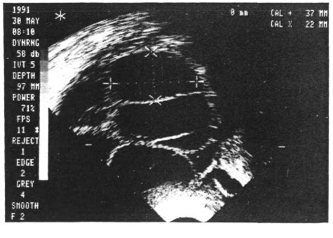 Figure From Complete And Partial Luteinized Unruptured Follicle