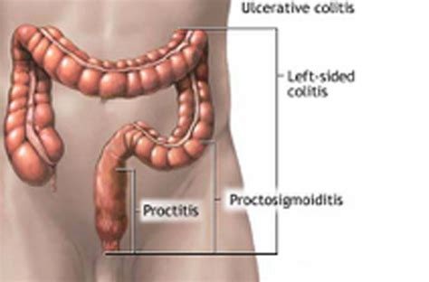 Mucous Colitis