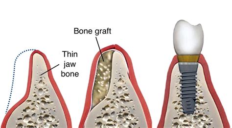 Bone Graft Dental Implant Pacific Oral Surgery