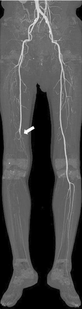 Occlusion of the right distal superficial femoral artery (white arrow)... | Download Scientific ...