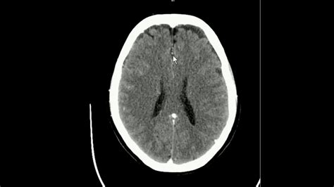 CT Crânio Axial ANATOMIA YouTube