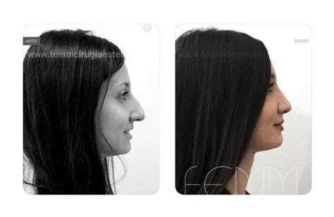 Rinoplastia Cirugía Estética Madrid · Clínica Femm