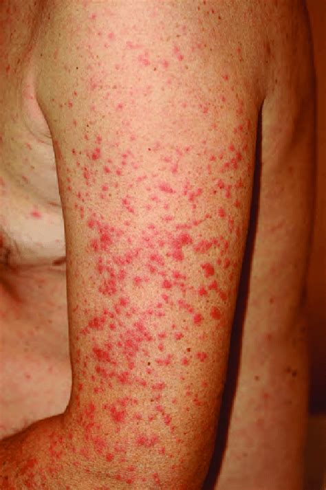 Erythematous Papular Rash