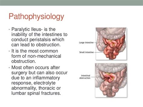 Paralytic ileus