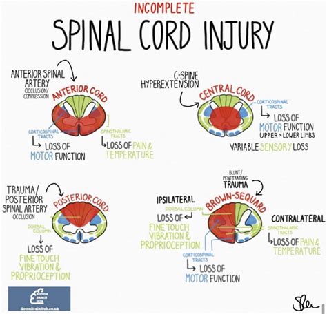 Oren Gottfried MD On Twitter Differentiating Spinal Cord Injury