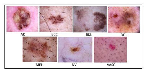 Figure From A Novel Framework Of Multiclass Skin Lesion Recognition