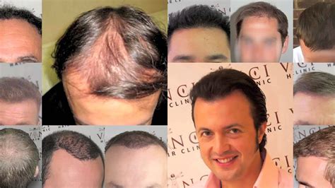 Transplante Capilar Vinci Hair Clinic YouTube