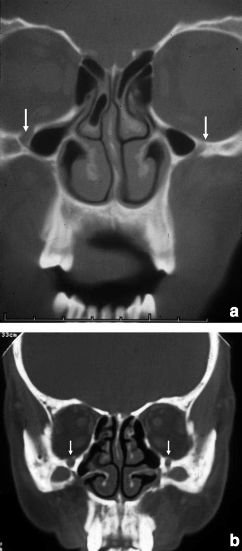 The Development And Pathologic Processes That Influence Maxillary Sinus