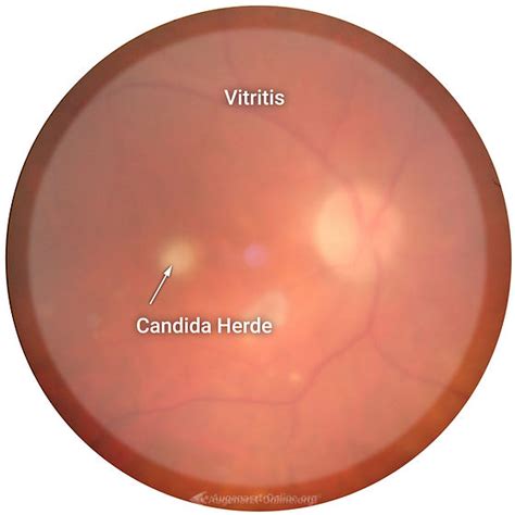 Candida Endophthalmitis Netzhaut Fundus Trainer