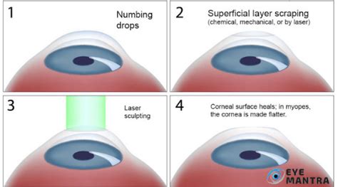 PRK Laser Eye Surgery Process Risks Benefits More EyeMantra