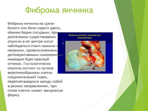 Фиброма яичника - online presentation
