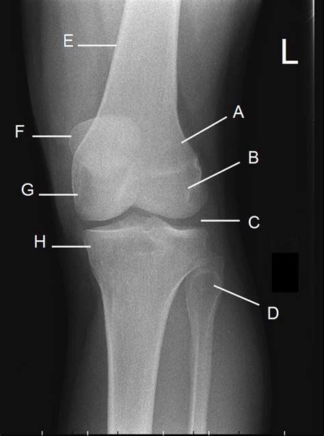 Internal Rotation Knee