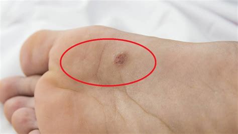 How To Get Rid Of Plantar Warts On Feet Home Remedies Fast And Easy