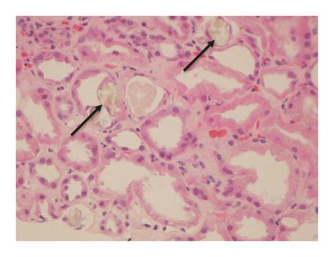 A Renal Biopsy Light Microscopy Stain Hematoxylin And Eosin Download Scientific Diagram