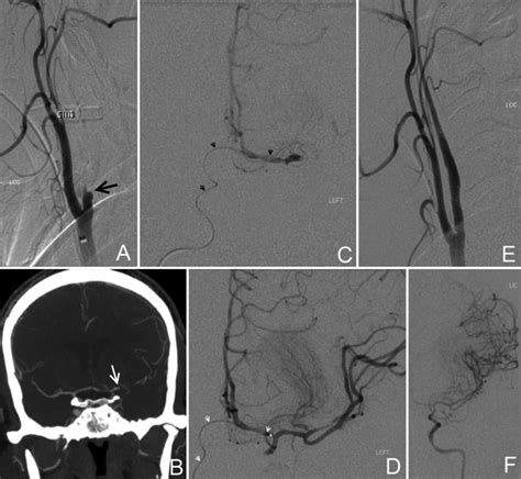 Case 2 A Left Cca Injection Lateral Cervical Angiogram Showing Left Download Scientific