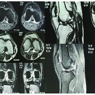 MRI of the right knee joint showing LCL and ACL injury. | Download ...