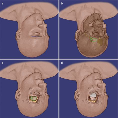 Supraorbital Approach Springerlink