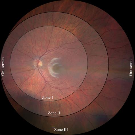 Retinopathy Of Prematurity Advances In The Screening And Treatment Of