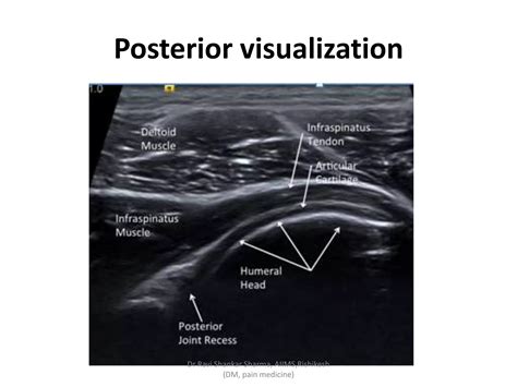 Diagnostic Ultrasound Of Shoulder Ppt