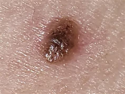 Early Stages Of Nodular Melanoma R Melanoma