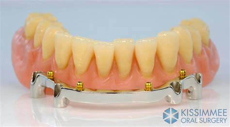 Bar Attachment Denture - Raphael A. Ason, DMD, MD