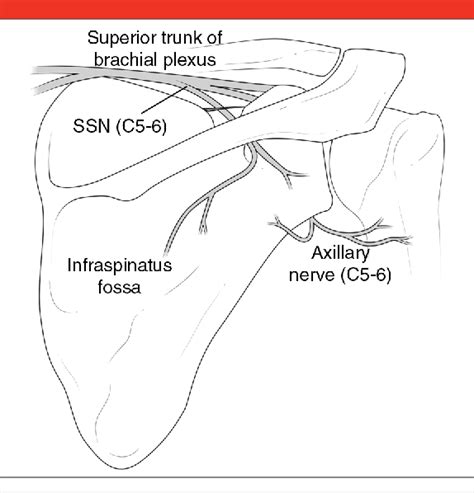 Figure 1 From Iatrogenic Nerve Injuries In Shoulder Surgery Semantic